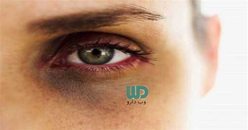 سیاهی زیر چشم چگونه درمان می شود؟