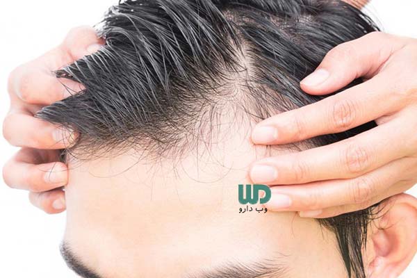 بررسی دلایل ریزش مو در مردان